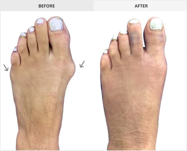 Bunion Surgery Before & After