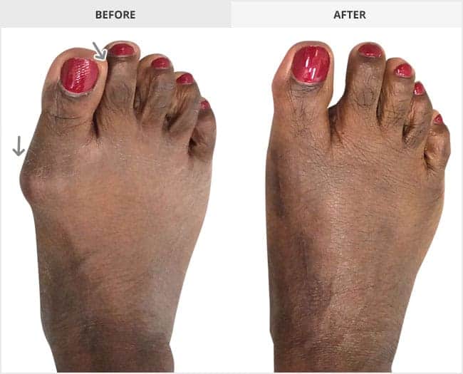 Bunion Surgery Before & After