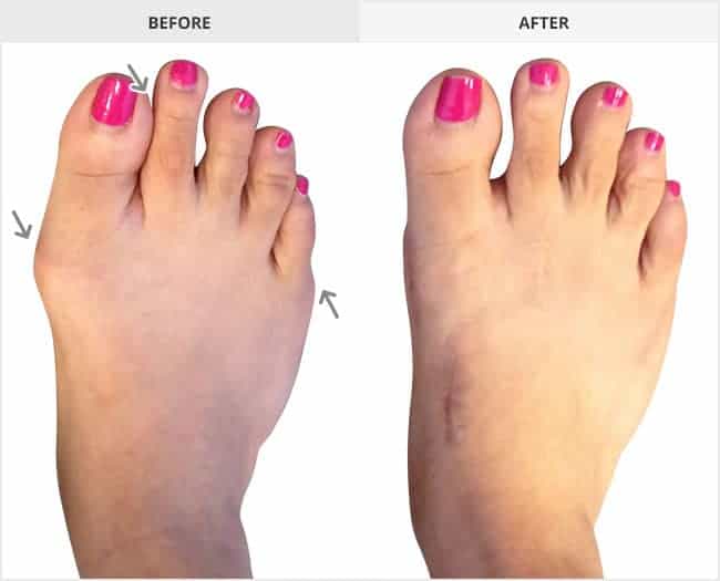 Bunion Surgery Before & After