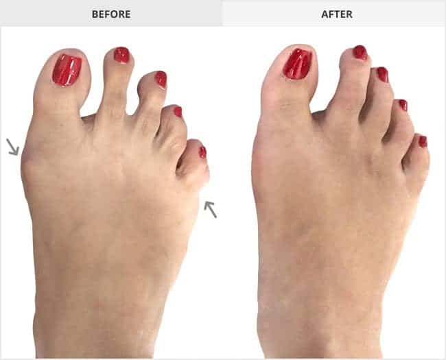 Bunion Surgery Before & After