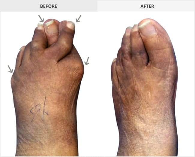 Bunion Surgery Before & After