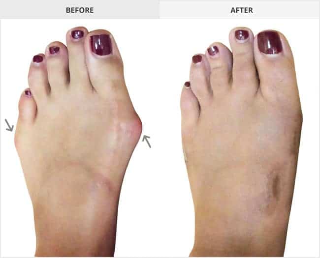 Bunion Surgery Before & After