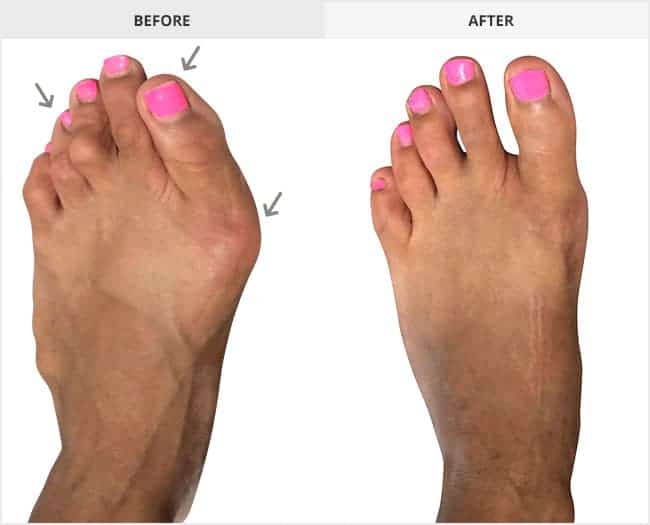 Bunion Surgery Before & After