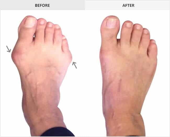 Bunion Surgery Before & After