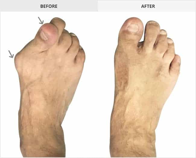 Bunion Surgery Before & After