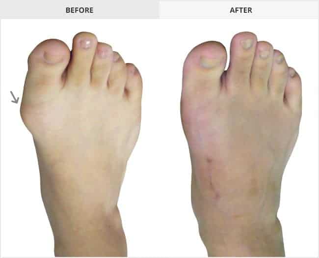 Bunion Surgery Before & After