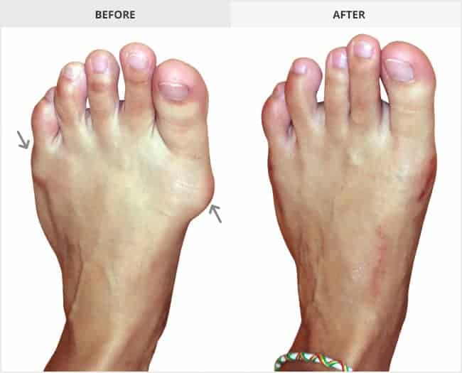 Bunion Surgery Before & After