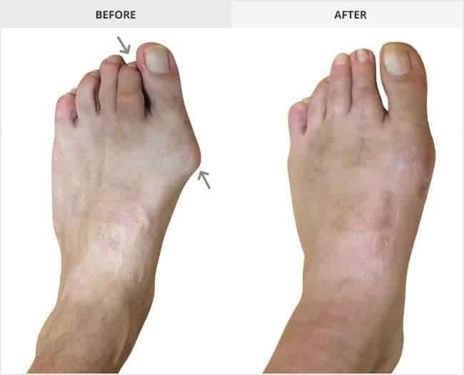 Bunion Surgery Before & After