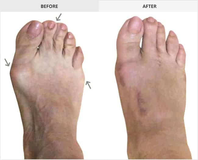 Bunion Surgery Before & After