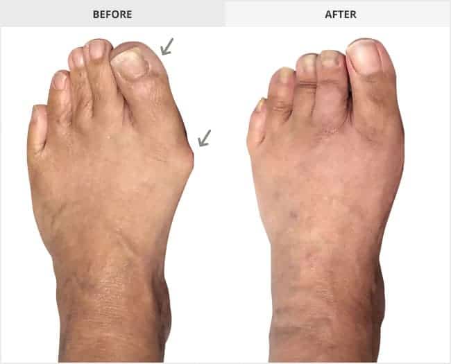 Bunion Surgery Before & After