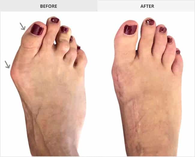 Bunion Surgery Before & After