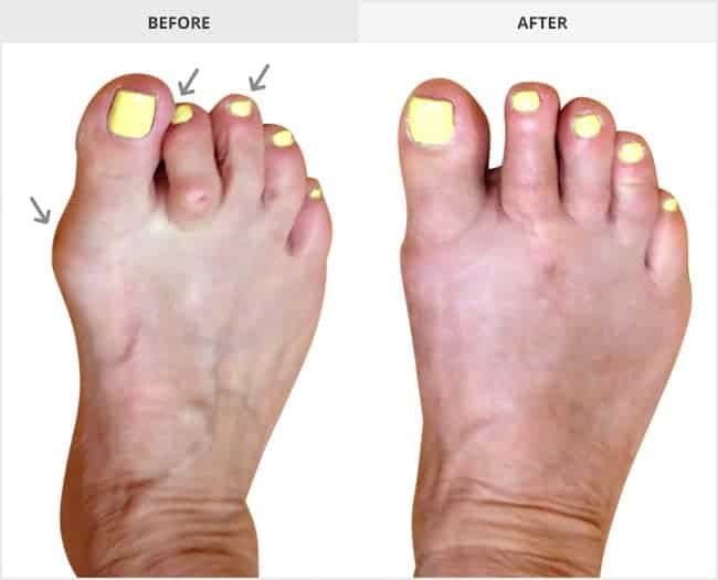 Bunion Surgery Before & After