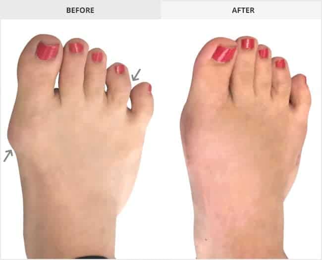 Bunion Surgery Before & After