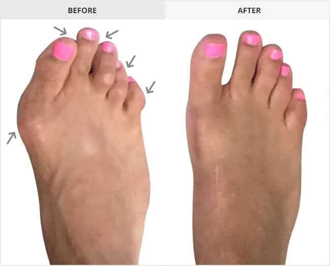 Bunion Surgery Before & After