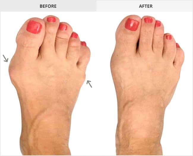 Bunion Surgery Before & After