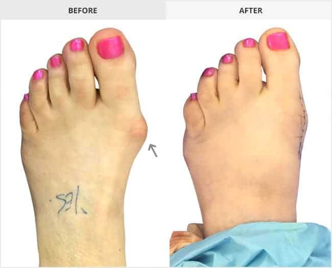 Bunion Surgery Before & After