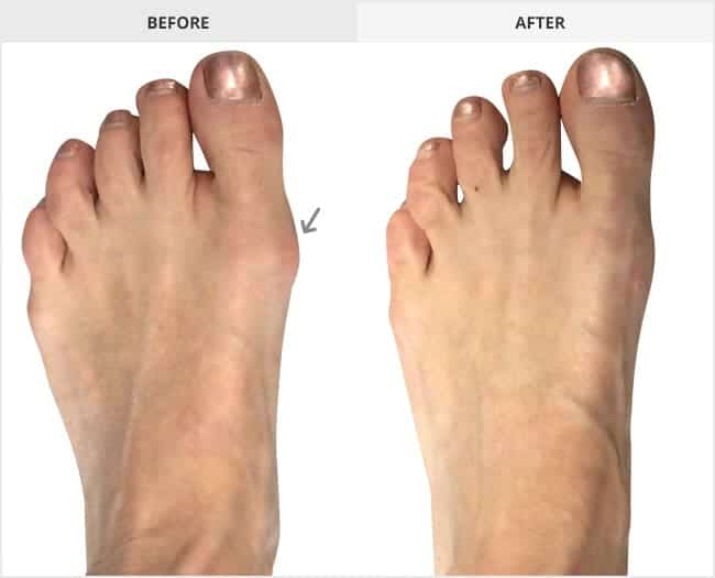 Bunion Surgery Before & After