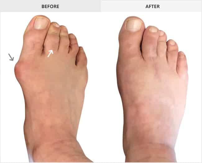 Bunion Surgery Before & After