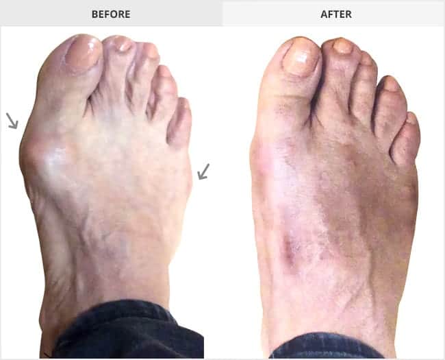 Bunion Surgery Before & After