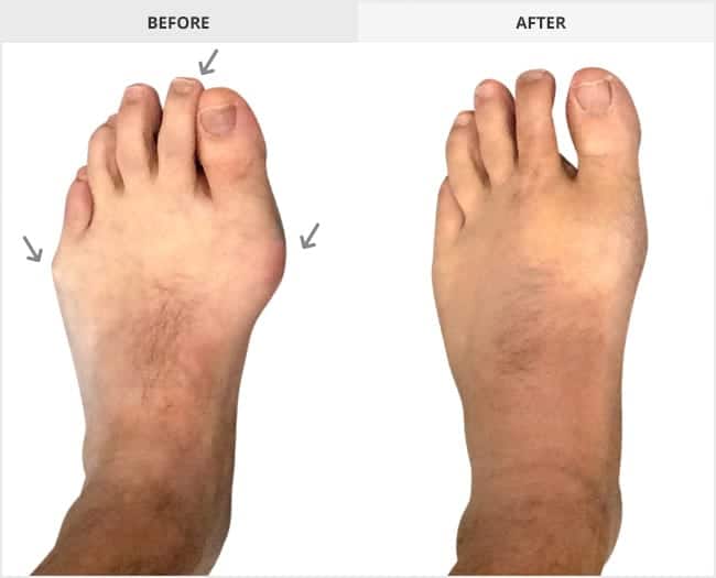 Bunion Surgery Before & After