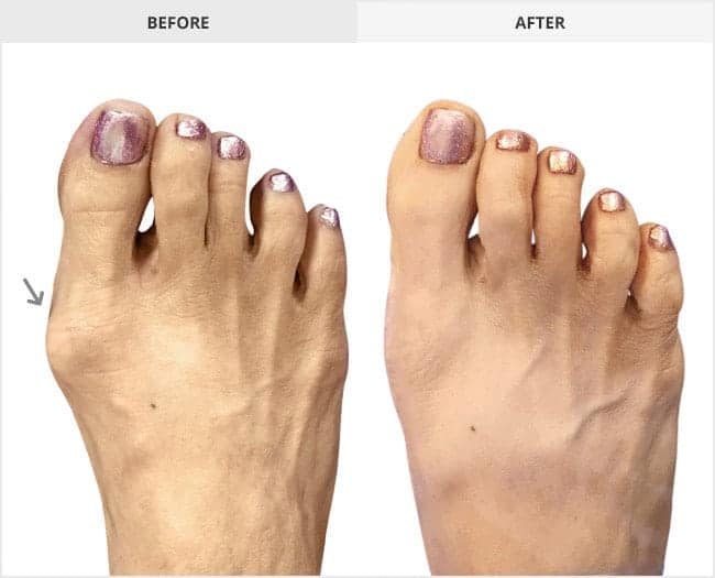 Bunion Surgery Before & After