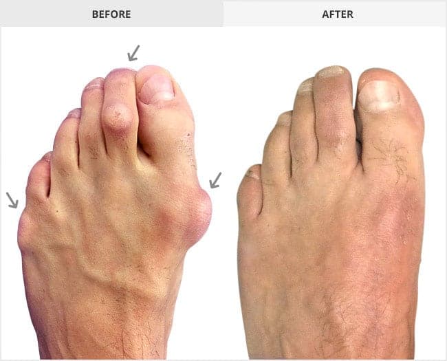 Bunion Surgery Before & After Gallery