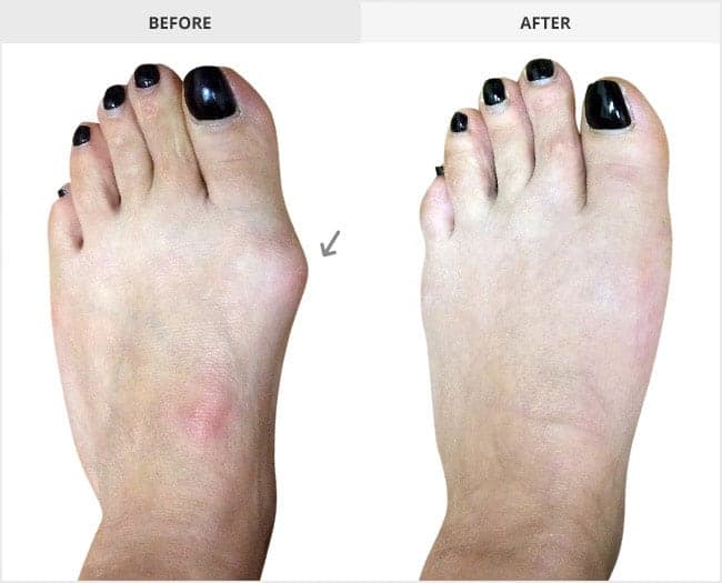 Bunion Surgery Before & After Gallery