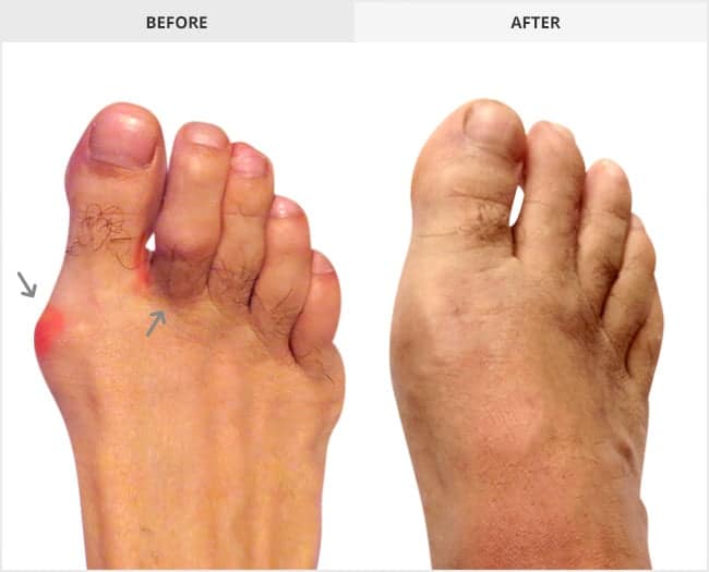 Bunion Surgery Before & After