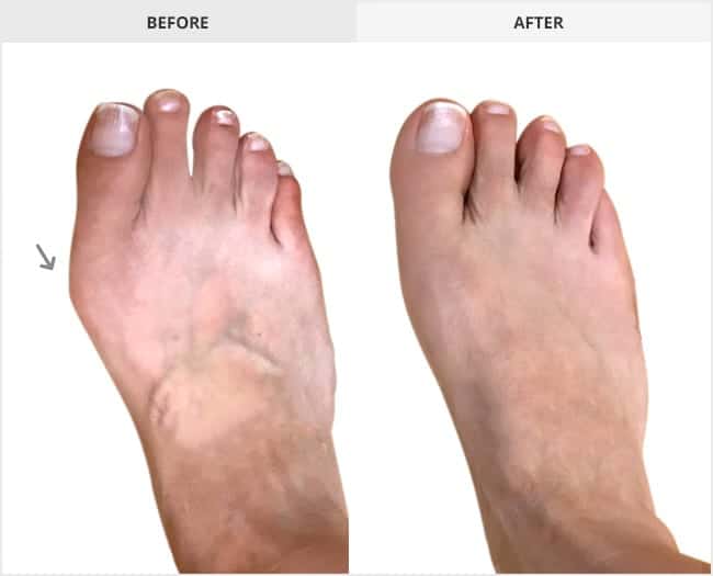 Bunion Surgery Before & After