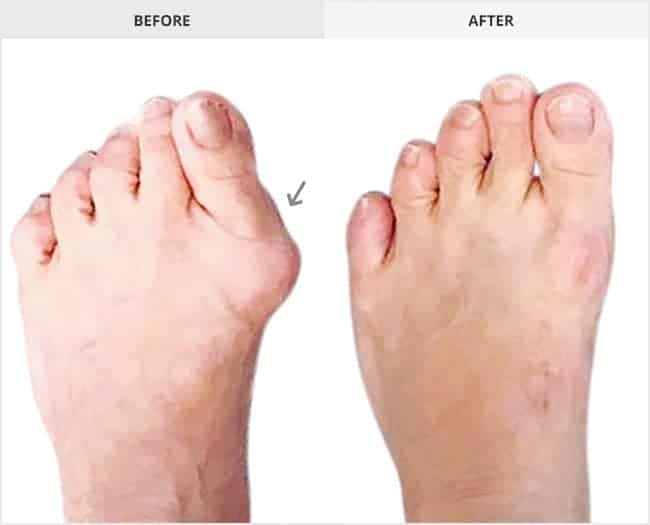 Bunion Surgery Before & After