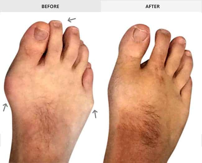 Bunion Surgery Before & After