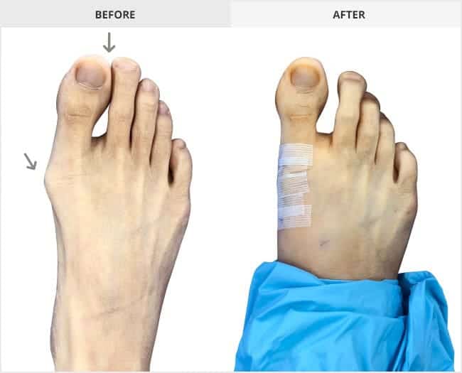 Bunion Surgery Before & After