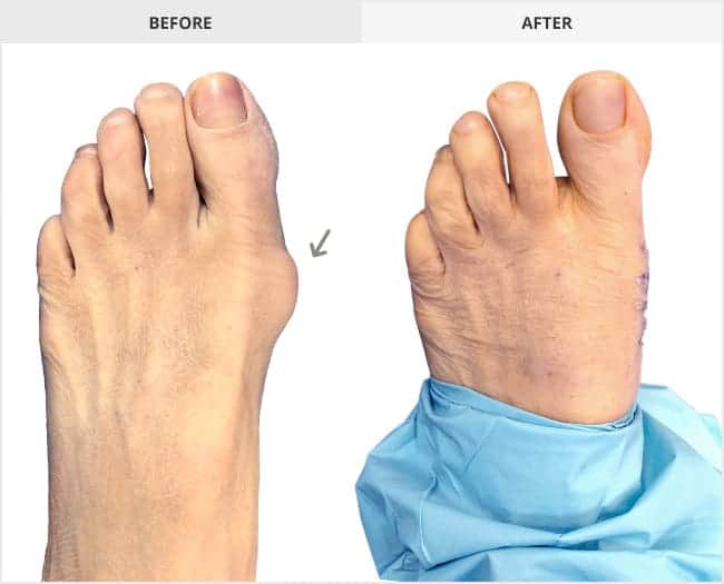 Bunion Surgery Before & After