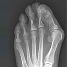 X-ray of a foot with bunion