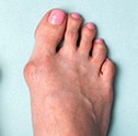 Image of a foot with a bunion