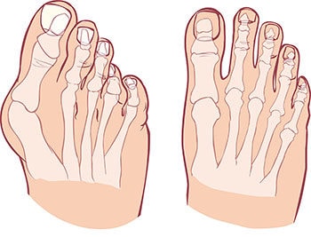 Bunion vs normal foot