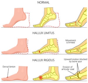 Progression of big toe arthritis