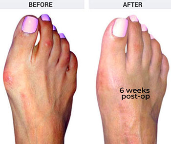 Minimally invasive bunion surgery recovery