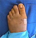 A foot with bandage after bunion surgery