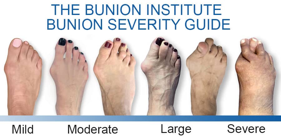 Bunion Severity Guide. The Bunion Institute of Los Angeles