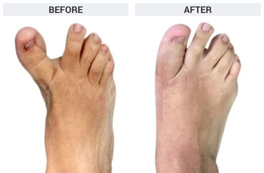 BUNION REVISION SURGERY