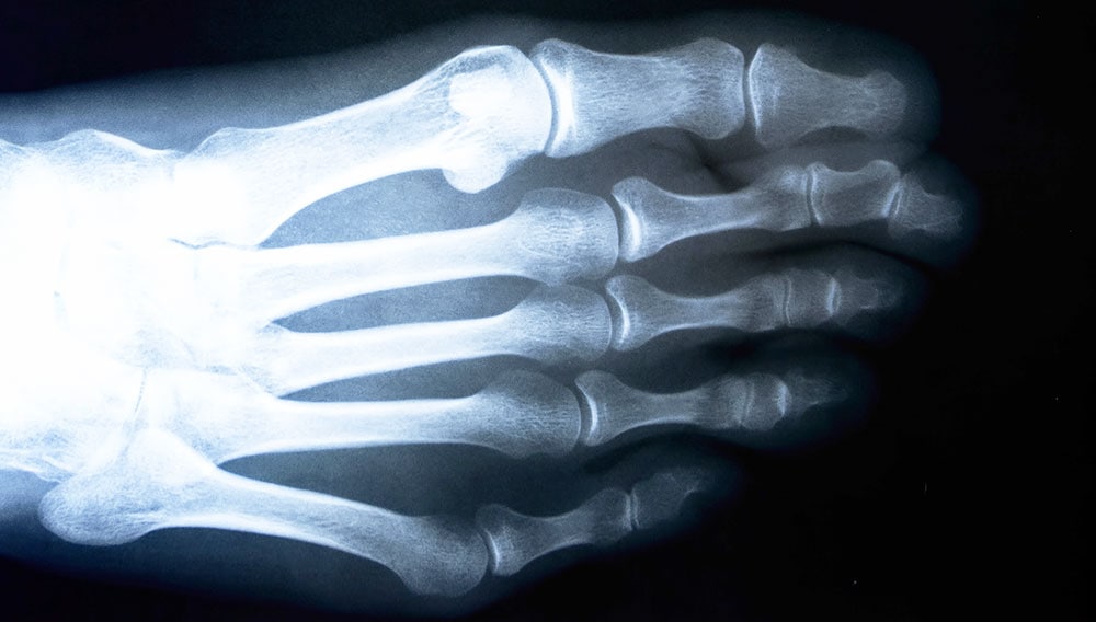 X-ray of a bunionette