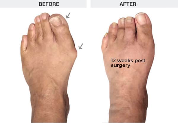 Minimally Invasive Bunion Correction