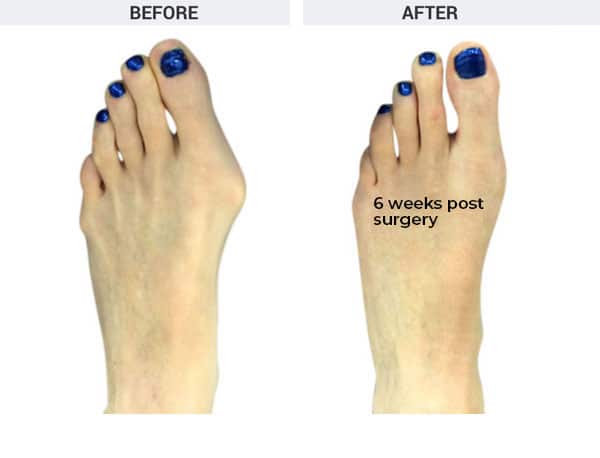 Minimally Invasive Bunionectomy