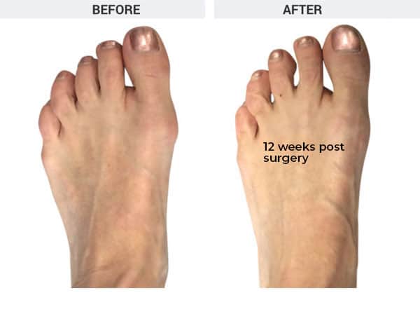 Minimally Invasive Bunion Correction Surgery