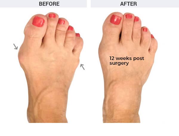 Minimally Invasive Bunion Surgery