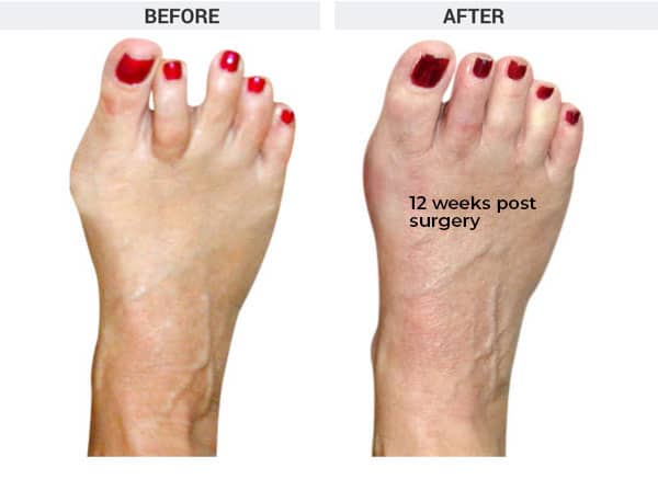 Minimally Invasive (MIS) Bunionectomy and Hammertoe Correction