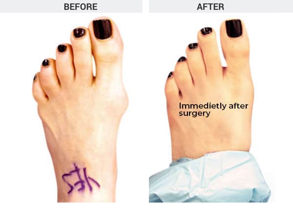 Minimally Invasive Bunionectomy and Tailor's Bunion Correction