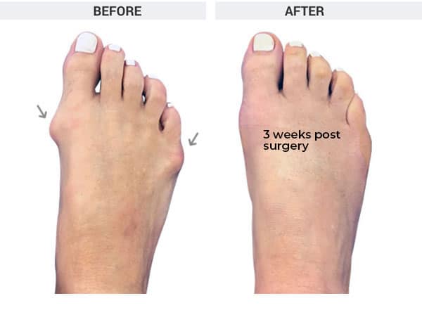 Minimally Invasive Bunionectomy and Tailor's Bunion Correction