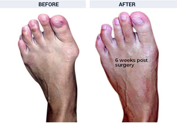 Osteotomy Bunionectomy